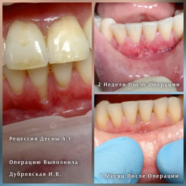 Рецессия десны