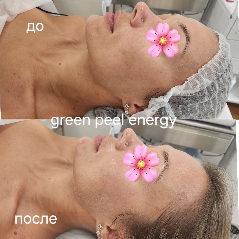До и после Green Peel