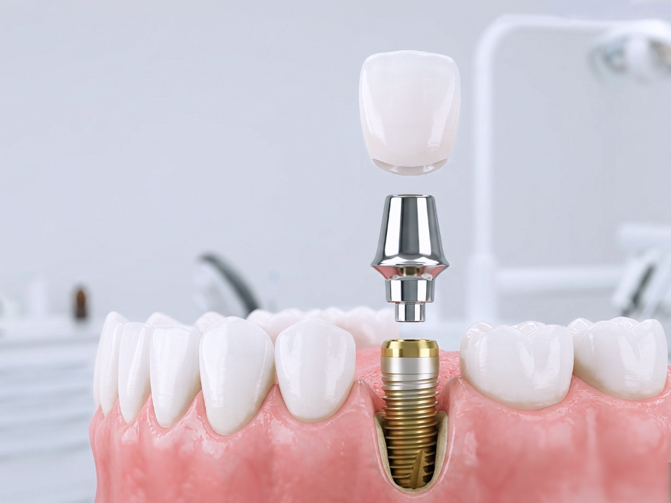 Скидка 10% на имплантацию зубов системой DENTIUM